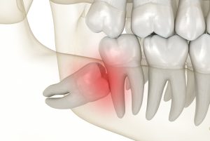 model of impacted wisdom tooth